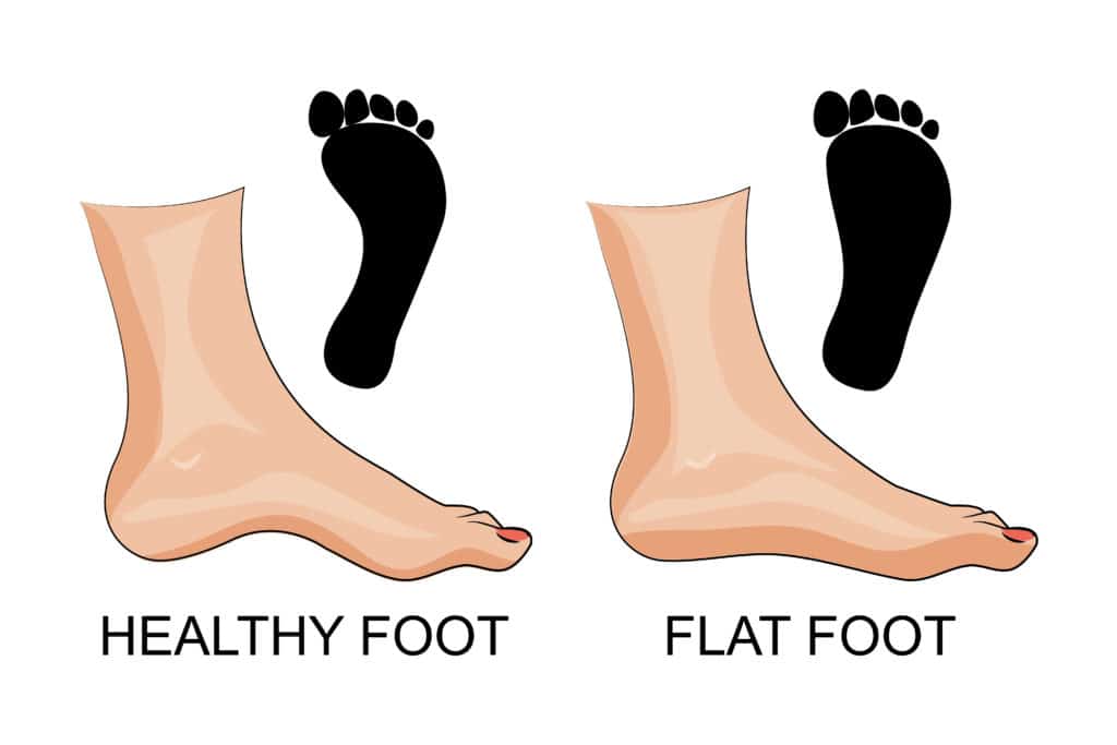 Flat Feet vs Healthy Feet 