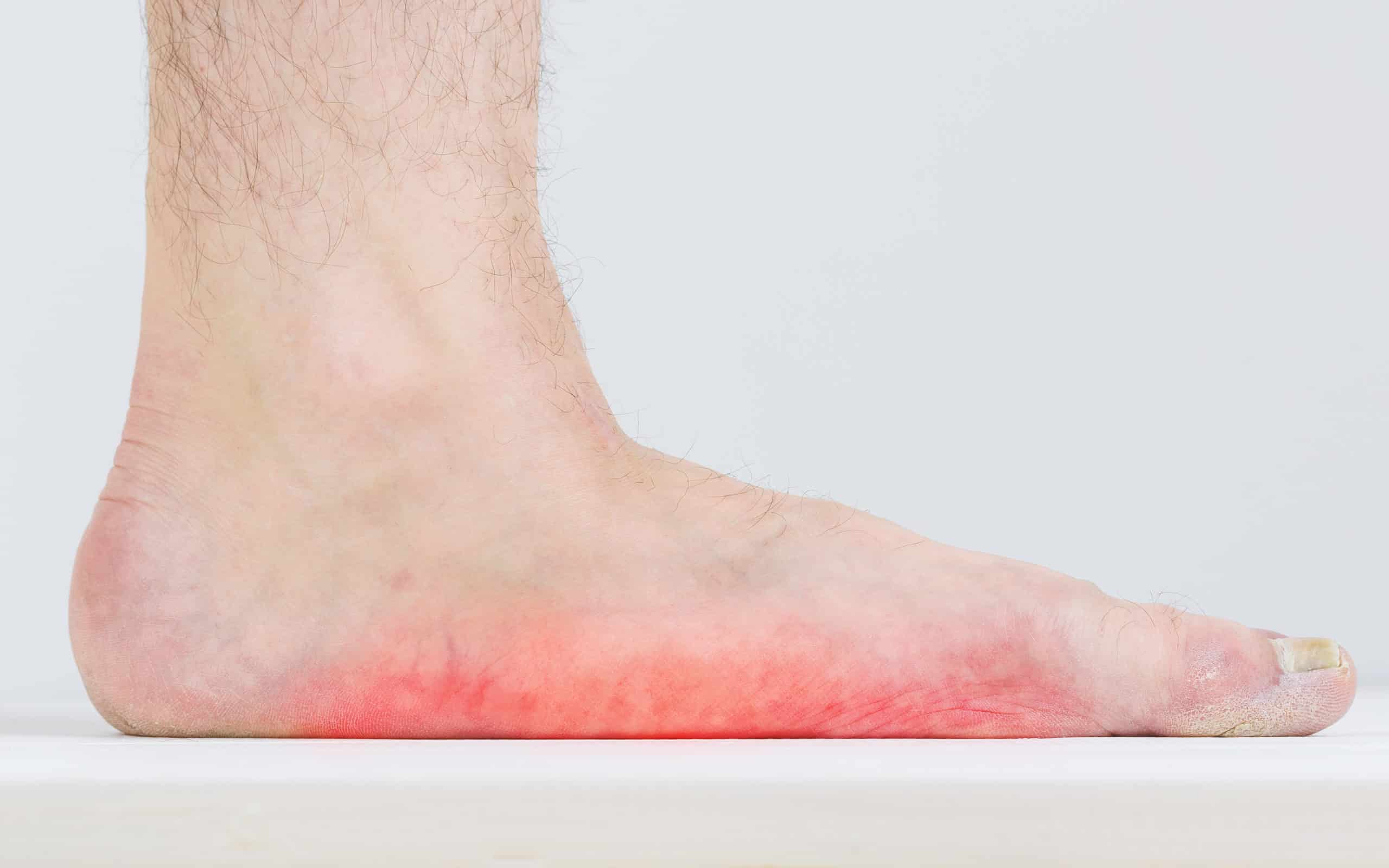 Are My Flat Feet Causing My Foot Pain? 