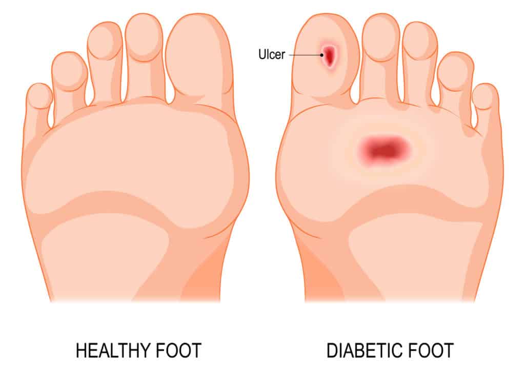 Diabetic Foor Ulcer 