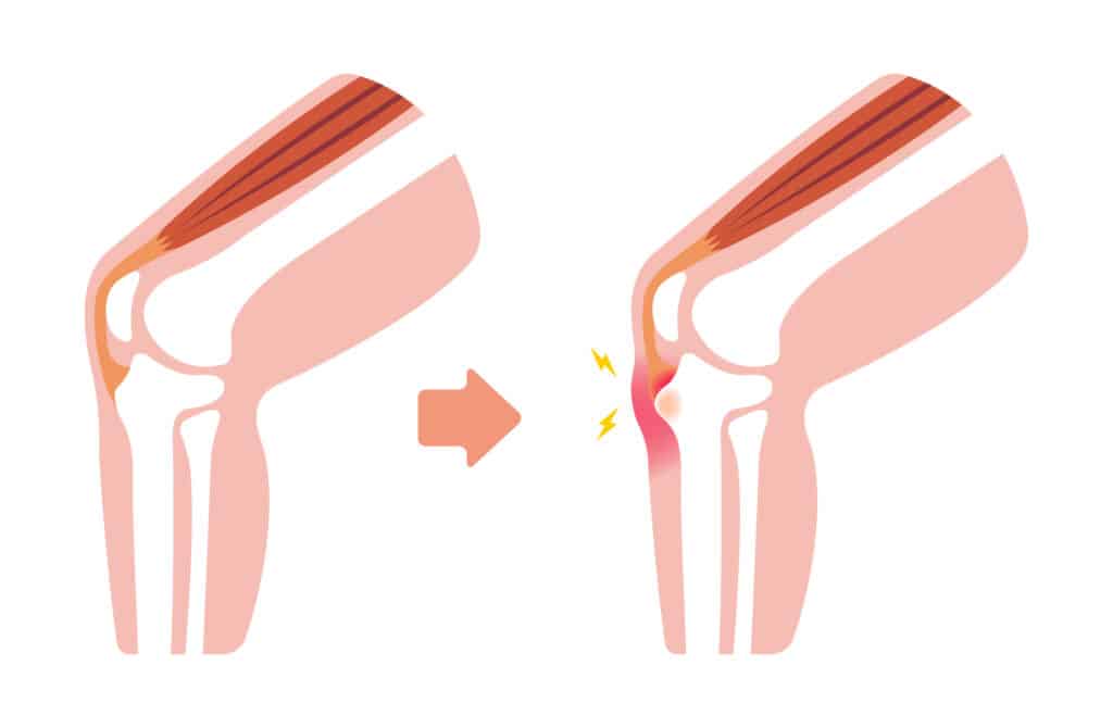 Illustration showing the inflammation from osgood schlatter 