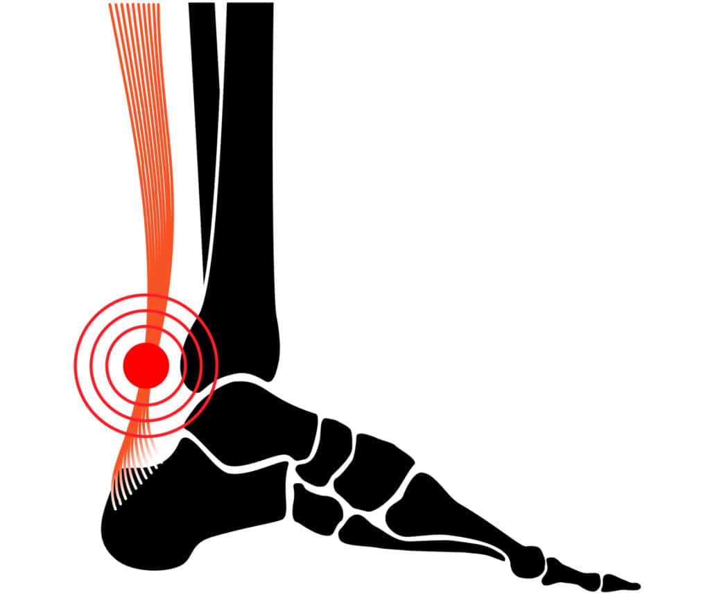 Sports Injury, Achilles Tendinitis & Physical Therapy 