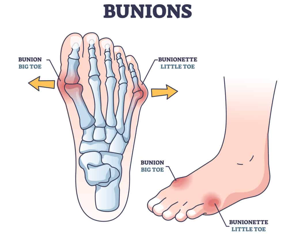 Diabetes Foot Care and Bunions 