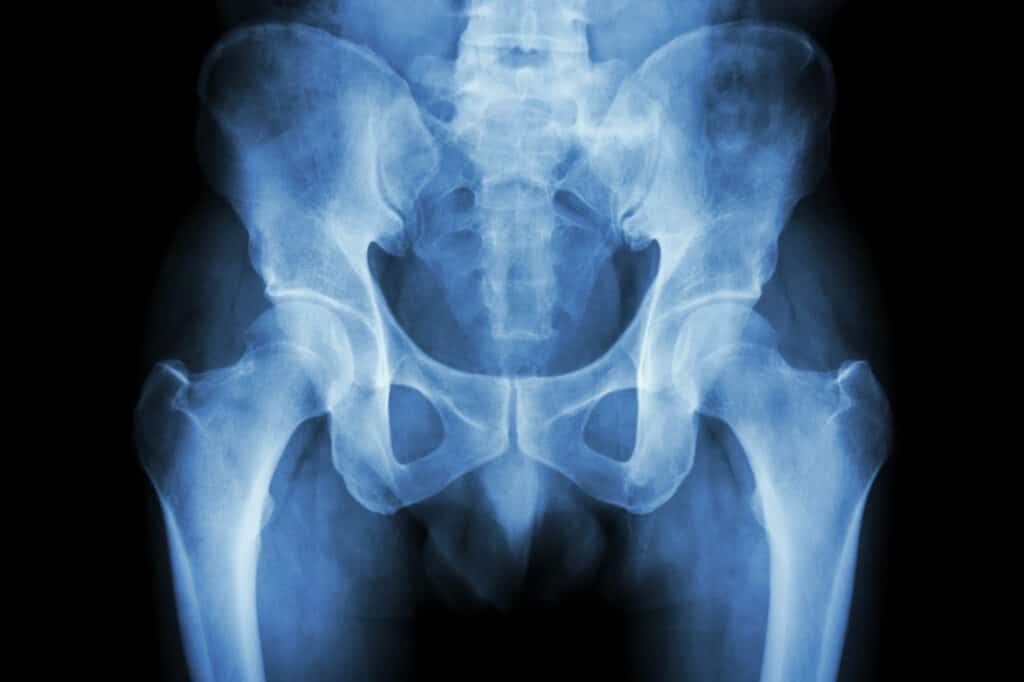 Film x-ray normal pelvis showing coccyx bone