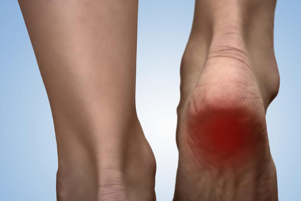 Heel Pain: Pain In The Hindfoot 