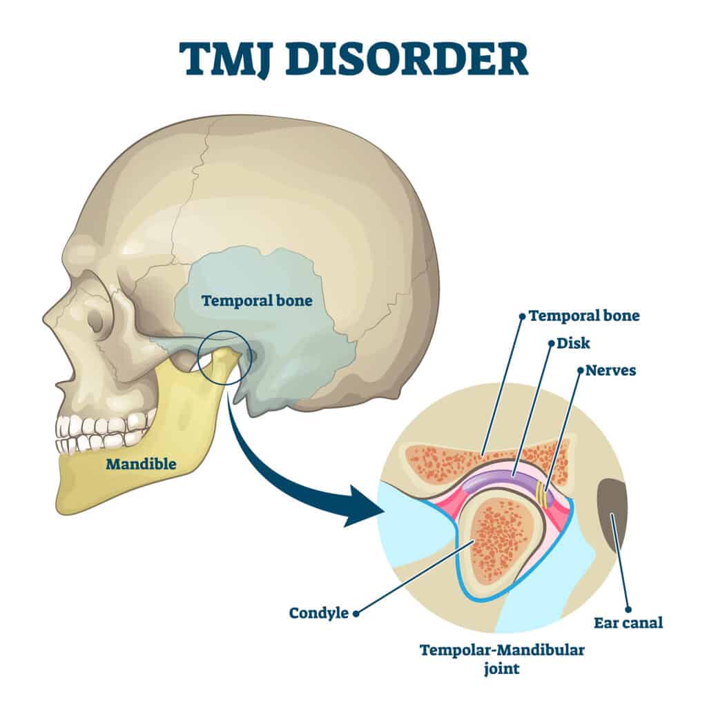 TMJ disorder causing jaw pain