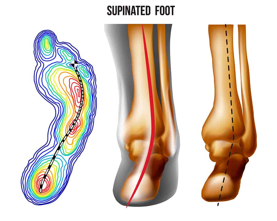 supinated foot